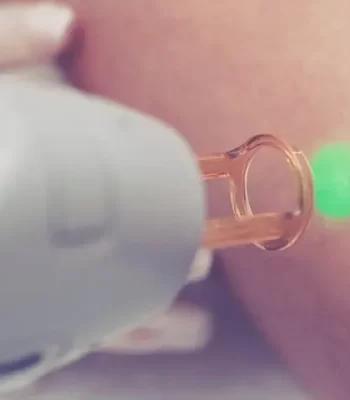 laser-transdermico